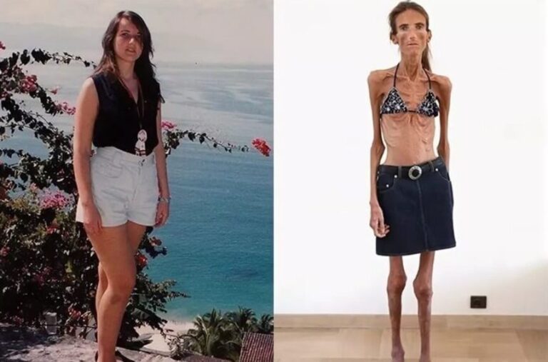 “Minus 40 kg — minus life.” But at first she was stunningly beautiful ...